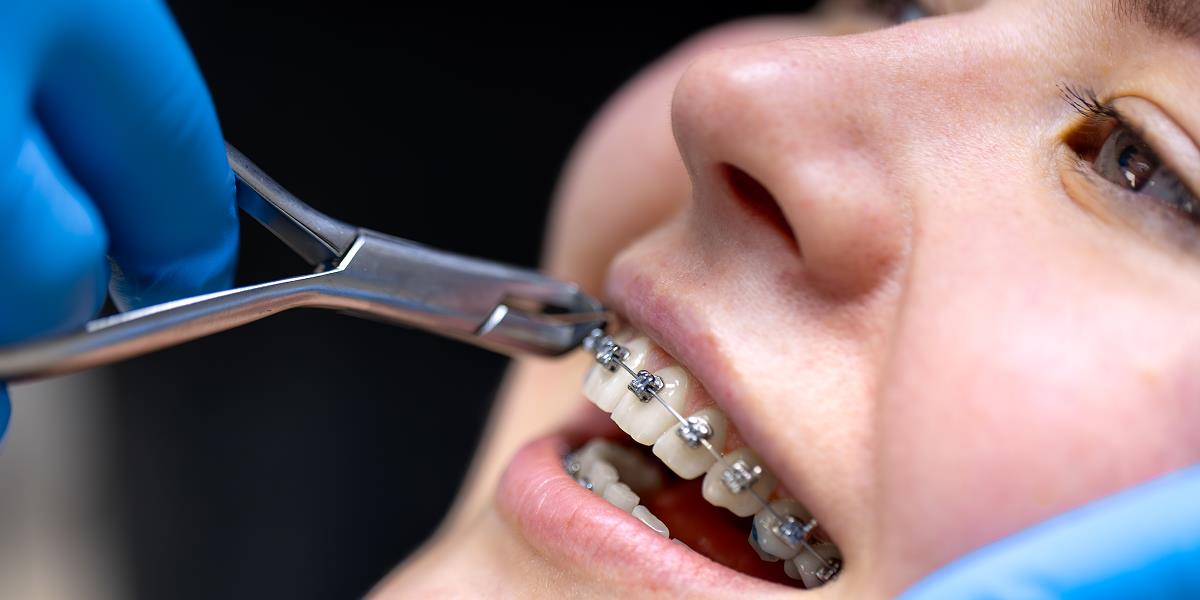 Braces Treatment in Gorakhpur: Types, Cost & Best Orthodontists